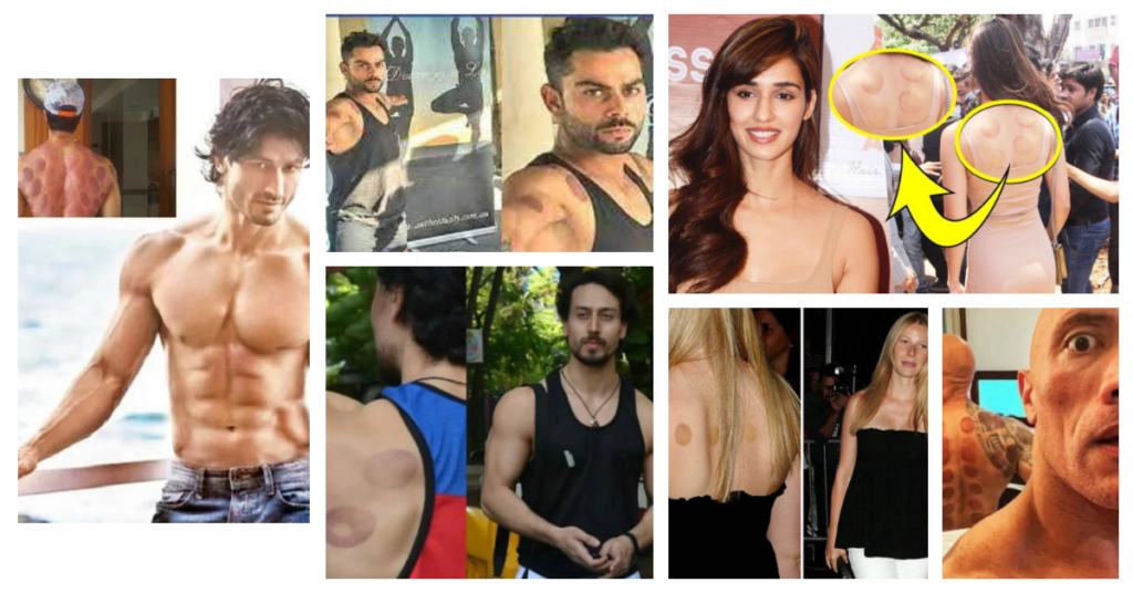 Cupping therapy benefits कपिंग थेरेपी के फायदे: सेलेब्रिटी जो चुन रहे हिजामा कपिंग थेरेपी का आनंद