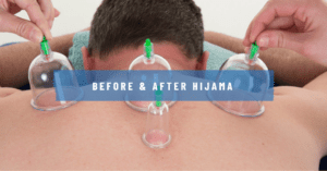 कपिंग थेरेपी के बाद की देखभाल प्रक्रिया Things to Do Before & After Hijama Process?