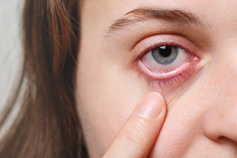 Doctor Warns Ranchi, Jharkhand Residents About Eye Flu